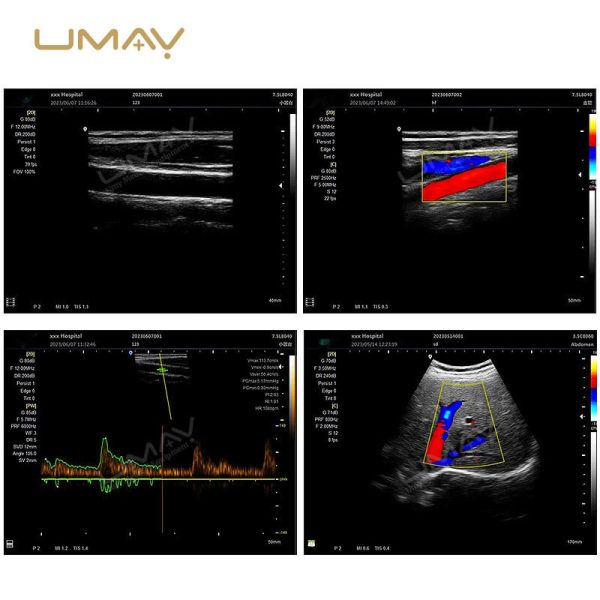 Value-Driven Color Doppler Ultrasound System with 15 Inch Display and ...